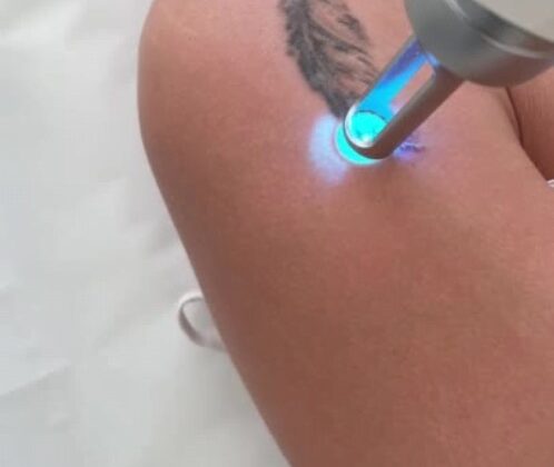 detatouage laser seance
