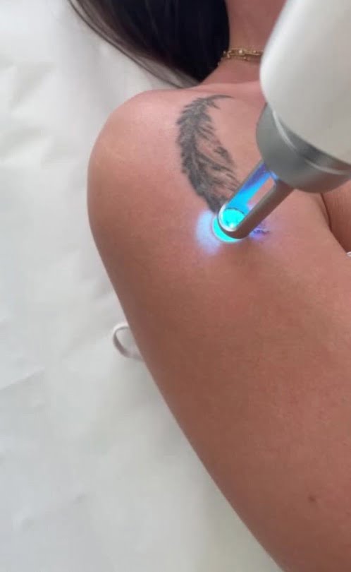 detatouage laser seance