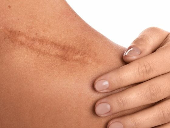 CICATRICE laser effacer