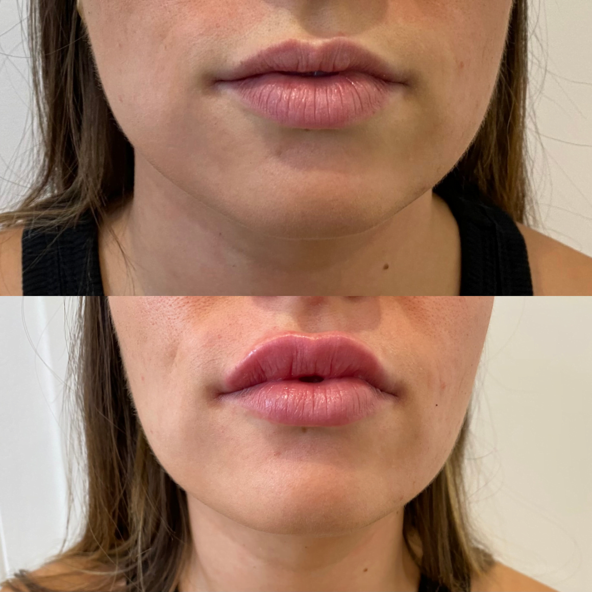 Exemple d'une injection d'acide hyaluronique dans les lèvres.
