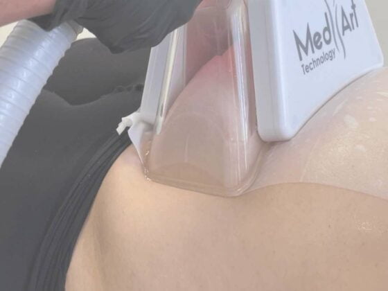 cryolipolyse medicale