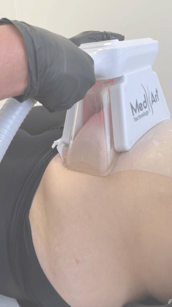 cryolipolyse medicale