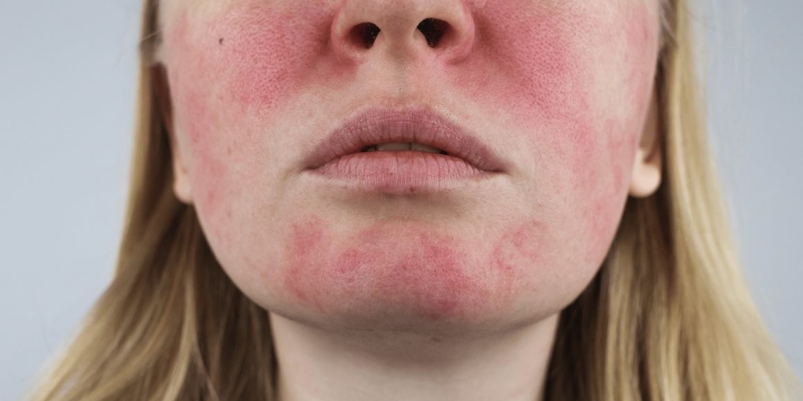 COUPEROSE laser traitement