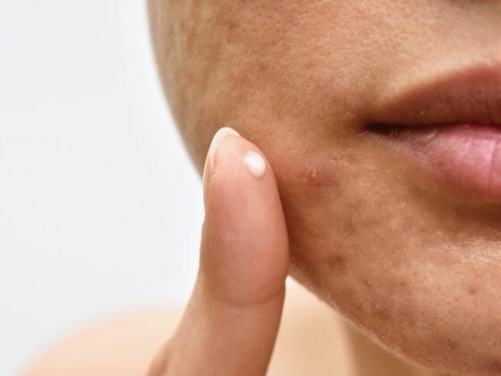 acne bouton traitement efficace dermatologue