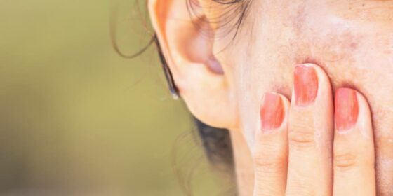 tache pigmentaire soleil traitement