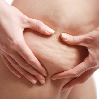 cellulite traitement efficace