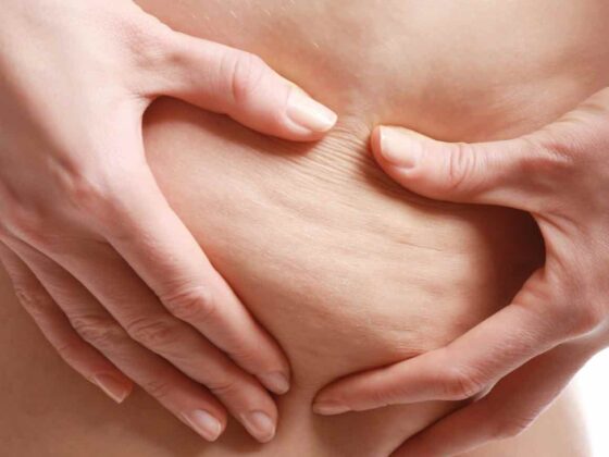 cellulite traitement efficace